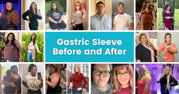 Gastric Sleeve Before and After Photos - The Best Pictures of 2022