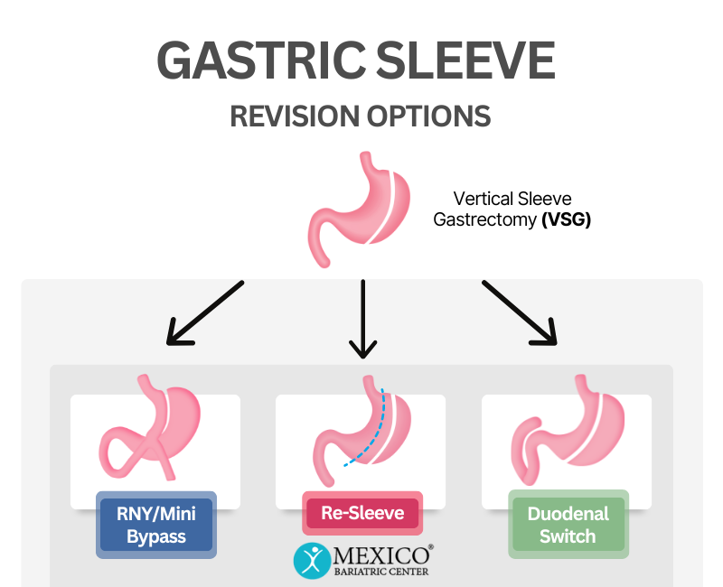 Gastric Sleeve Revision Options -Mexico Bariatric Center