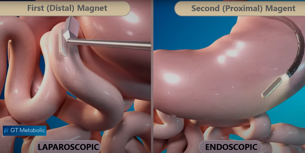 First and Second Magnets - Laparoscopic and Endoscopic - GT Metabolic 